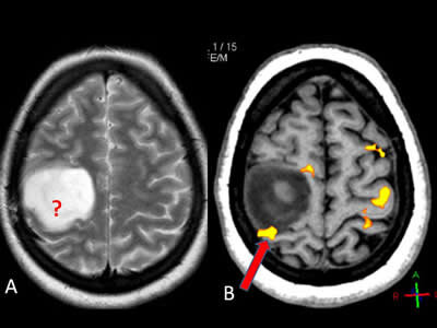 Se comienza a explorar contra el cancer.