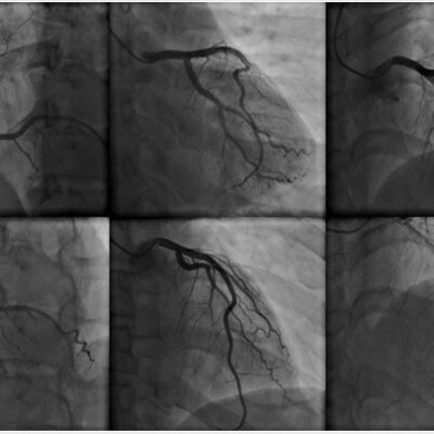 Timeline: ANGIOGRAFIA