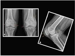 Gota Forssel fue el primero en usar radiografías de detalles