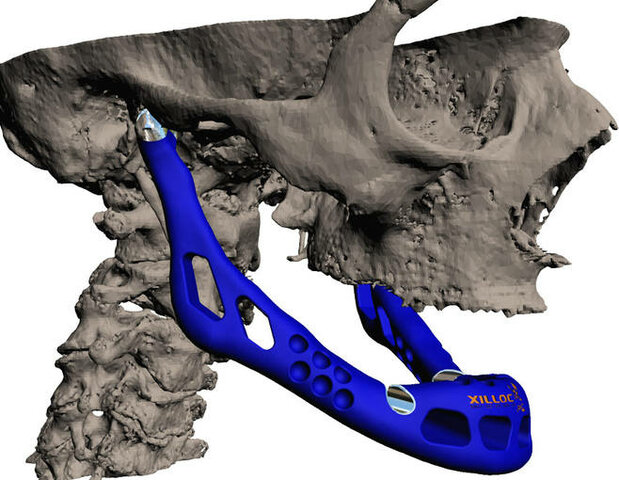 Trasplante de Mandíbula Impresa