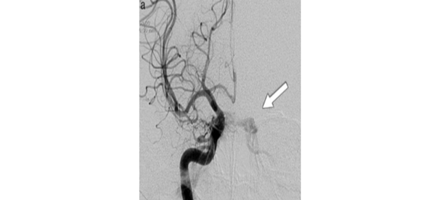 ANGIOGRAFÍA CEREBRAL