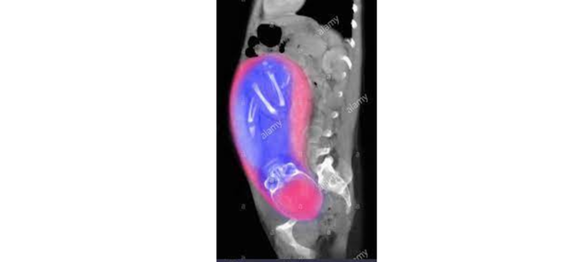 TOMOGRAFIA COMPUTARIZADA