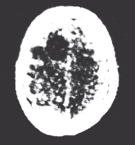 Se crea la TAC y se hace la primera exploración en un paciente