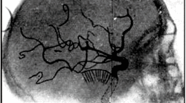 Timeline: Angiografía