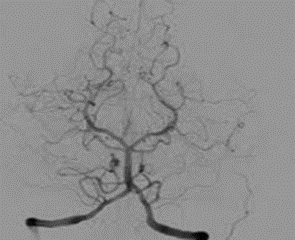 Angiografía por contraste radiopaco