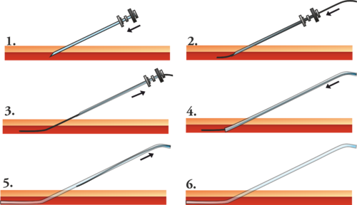 Técnica de Seldinger