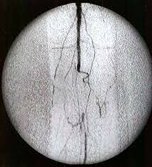 Angiografía por contraste radiopaco