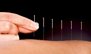 Acupuntura