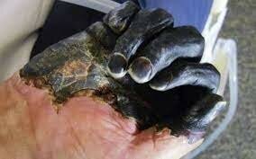 Muerte negra  (La enfermedad y la superstición)