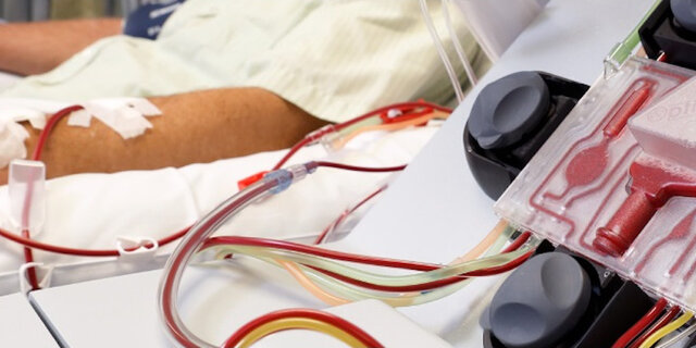 Se desarrolla la hemaféresis de flujo discontinuo