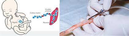 Primer trasplante de células progenitoras de cordón umbilical