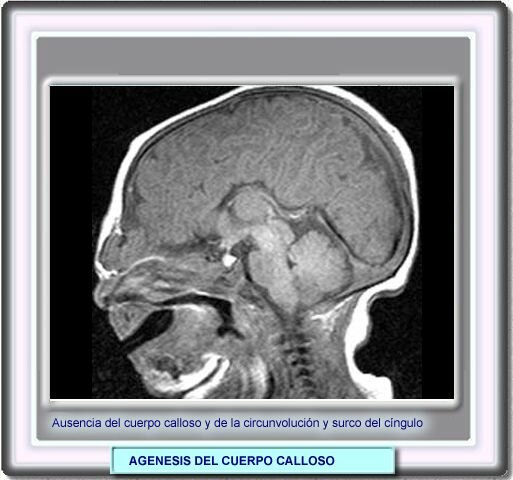 Problema en el desarrollo: Agenesia cuerpo calloso