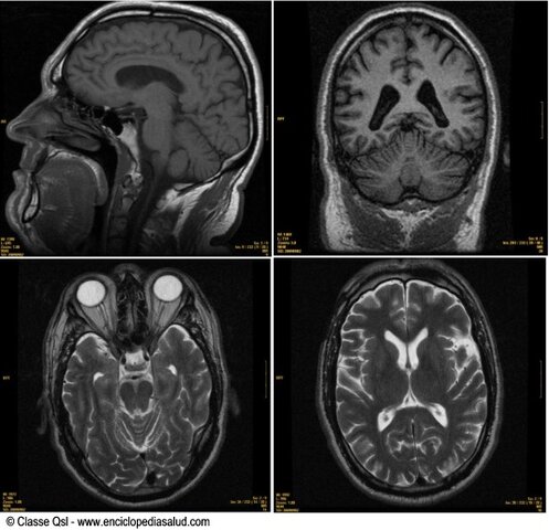 Resonancia magnética nuclear