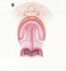 Francia (LE MONTIER)