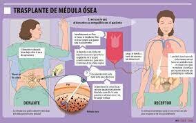 Primer trasplante de médula ósea en México