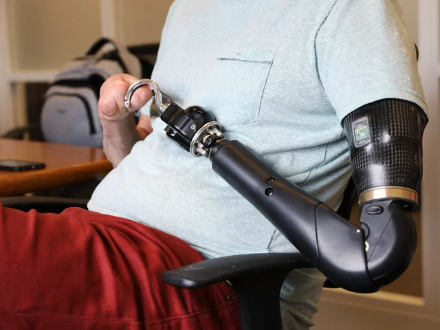Bionic Prosthetics