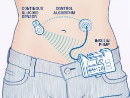 The World’s First Artificial Pancreas