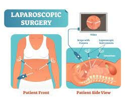 Laparoscopic surgery