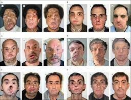 Face transplants