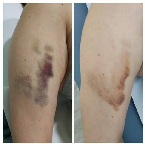 lesiones musculares extrínsecas