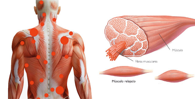contractura muscular