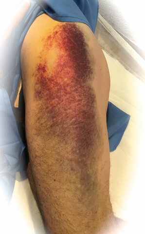 rotura muscular total