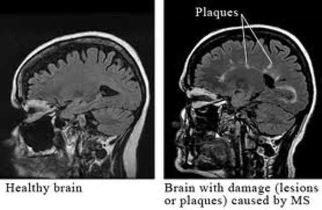 Multiple Sclerosis recognized