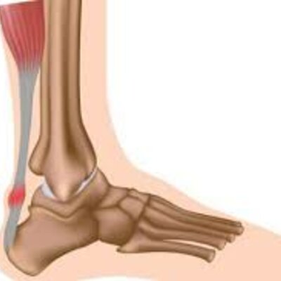 Timeline: Lesiones Tendinosas