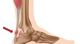 Timeline: Lesiones Tendinosas