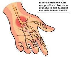 Tendinitis