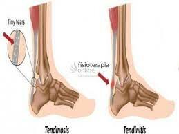 Tendinosis
