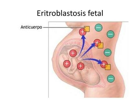 Planteamiento de la isoinmunización materno-fetal como causas de la eritroblastosis fetal