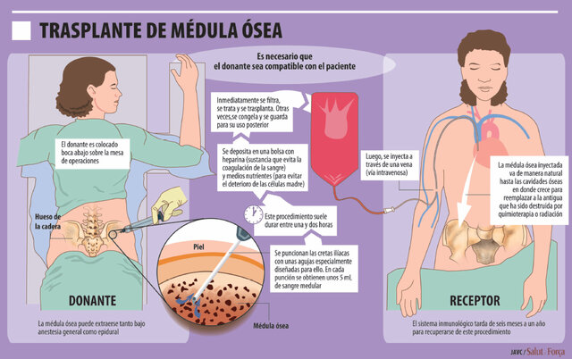 Primer trasplante de médula ósea en México