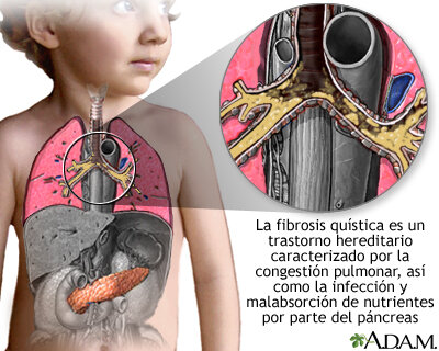Un tratamiento para la fibrosis quística