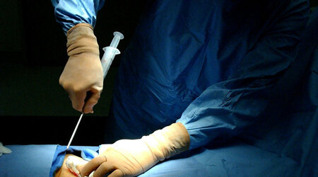 Primer trasplante de la médula osea