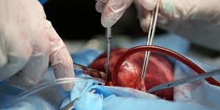 Primer trasplante de corazón
