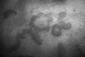 Primeras quemaduras y dermatitis debidas a la exposición