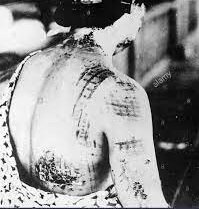 Aumento casos por exposición a rayos X