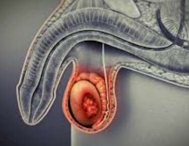 Se descubrió el cáncer del escroto