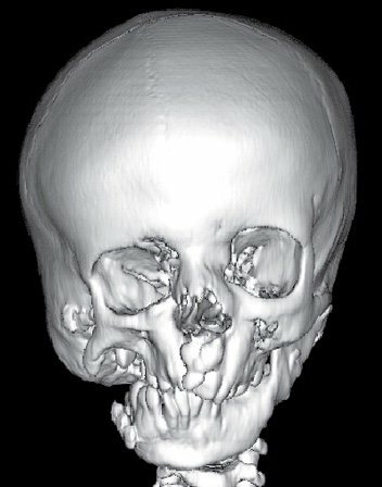 Sindrome de goldenhar