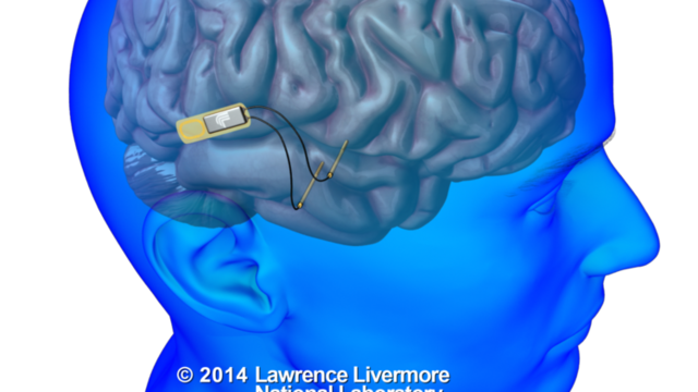 Implantes de memoria