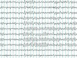 ¨Electroencefalograma¨