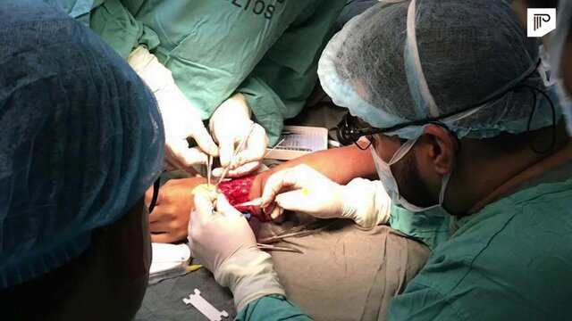 PRIMER IMPLANTE DE MANO