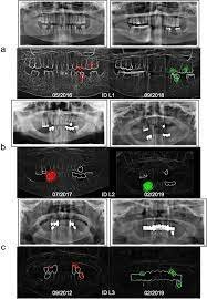 Four second dental match - Japanese researchers develop a dental x-ray matching system.