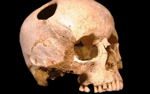 Primeiras evidências de Trepanação