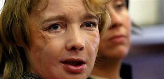 Primer transplant de cara