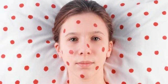 Último caso de Viruela en el mundo