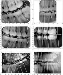 Four second dental match