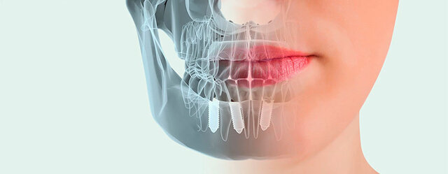 La implantología dental como opción terapéutica.