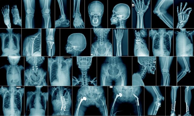 X-RAY